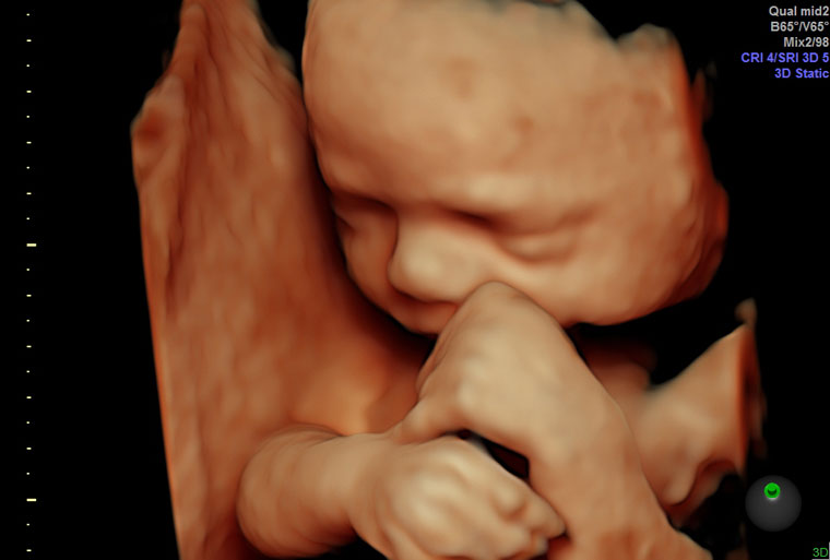 Υπερηχογράφημα τρισδιάστατο (3D & 4D) Κέντρο Ιατρικής Εμβρύου Ιωάννινα 
